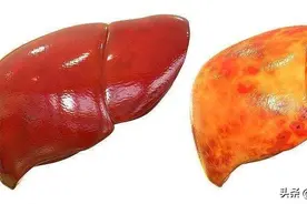 轻微肝损伤，如何自我调理补救图片