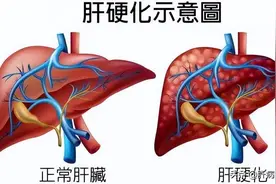 肝硬化临床总结！能活多久？会不会疼痛？有何表现？图片