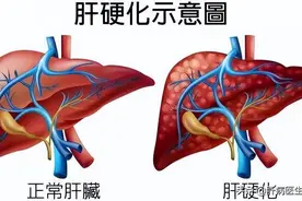 肝硬化临床总结！能活多久？会不会疼痛？有何表现？图片