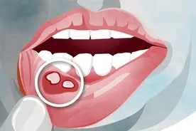 健康早知道：经久不愈的口腔溃疡，要警惕口腔癌图片