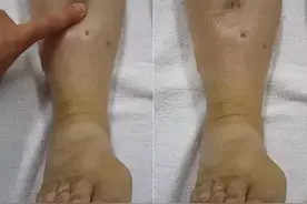 什么情况下会发生静脉血栓？静脉血栓应该如何预防和治疗？图片