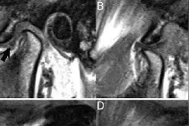颞下颌关节病磁共振诊断要点图片