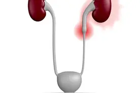 肾结石复发，我是如何把1.1cm的结石排出来的？图片