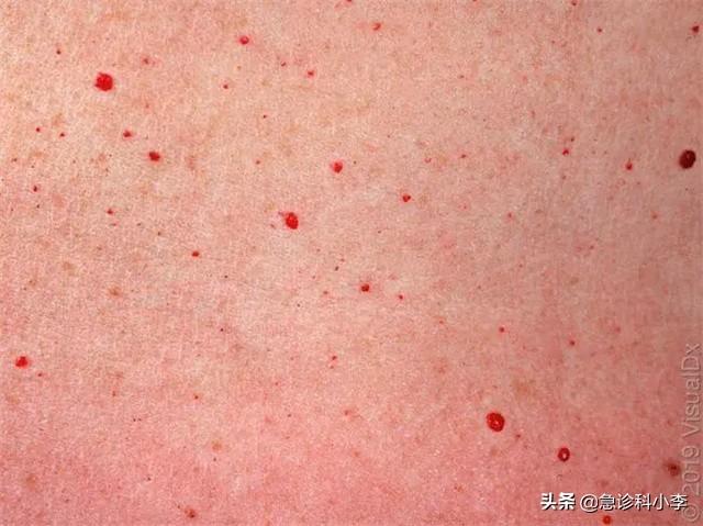 小腿鸡皮肤站久了红点