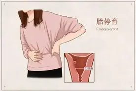 胎停育不是突如其来，这两种信号要警惕！图片