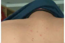 螨虫最怕的东西是什么？床上放点“它”，螨虫一夜之间消失不见！图片