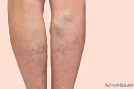 下肢静脉曲张？竟是心和小肠的问题，倪海厦教你静脉曲张怎么治图片