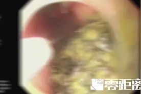 9岁女童反复恶心、呕吐！罪魁祸首竟是腹中的2斤重“毛球”图片