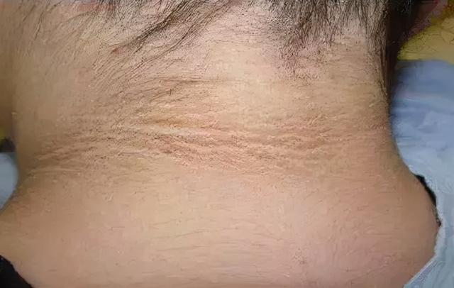 痣角化是癌吗