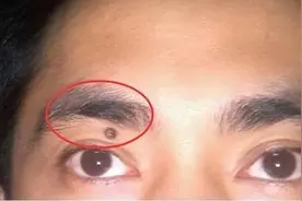 痣为什么会长毛？是皮肤癌的表现吗？提醒：这3种痣提高警惕图片