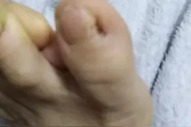 脚趾有个窟窿图片