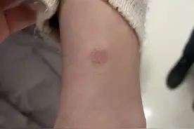 猫癣并没那么可怕，了解这些就很好治愈，铲屎官别吓唬自己图片