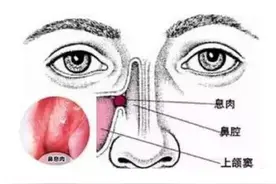 科普知识：鼻子里长了鼻息肉该怎么办？图片