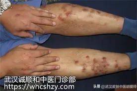 小腿皮肤粗糙发出一个一个的褐色小疙瘩剧痒吃什么药能止痒图片