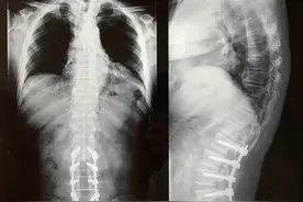 门诊病历：腰椎术后近两年，走路两腿沉重，迈步困难，行走不稳图片