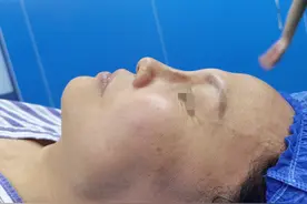 10年假体在鼻内翻转，取出后直言活受罪，公开真实记录图片