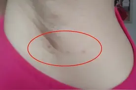 脖子和腋下的“小肉粒”是什么？能直接用手揪掉吗？看完要记牢图片