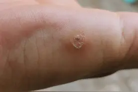 手上长出来的东西，竟然是一种“疣”图片