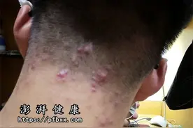 背后脖子后面皮肤上长了红痘痘火辣辣的疼用什么药膏怎么消除图片