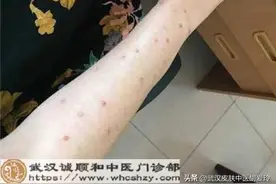胳膊腿上长红色的肉疙瘩很硬很痒怎么办吃啥药能治好啊图片