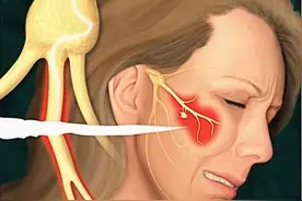 一针去除“天下第一痛”。市立医院神经外科微创治好三叉神经痛图片