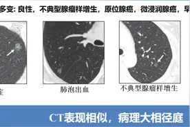 什么样的磨玻璃结节才是肺癌的前兆？图片
