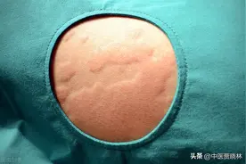 一个千古奇方“防风通圣丸”，不仅缓解荨麻疹，这几个病症也可用图片
