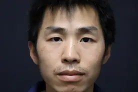 误把鼻中隔偏曲当鼻炎，35岁男子痛苦十余年。矫正后“如获新生”图片