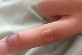 寻常疣冷冻治疗过程图片