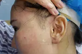 有人说拉皮后疤痕会很明显，足足二指宽，亲身经历分享给大家图片