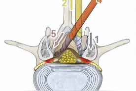临床经验｜ENDO-ULBD手术治疗腰椎管狭窄症分享图片