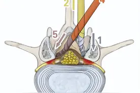 临床经验｜ENDO-ULBD手术治疗腰椎管狭窄症分享图片