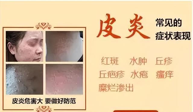 鏄ュぉ鐨偆鐥呰繘鍏ラ珮鍙戝锛佽繖浠界敤鑽ぇ鍏ㄨ鏀跺ソ