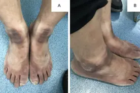 水源性角化皮病是怎么回事？图片