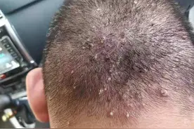 夏天来了，头皮毛囊炎怎么办？医生提醒：三点建议，或可消退图片