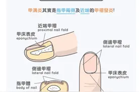 你为什么会得甲沟炎？又该如何防治呢？图片