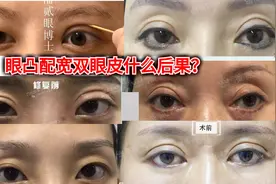 凸眼睛者：眼球突出、上睑凹陷或多层，双眼皮设计为何不宜过宽？图片
