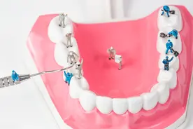 纯钛活动假牙有什么优点，安装后注意事项图片