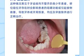 健康·科普 | 你要的“拔牙指南”科普，发货啦！图片