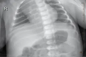 新生儿肺炎，常见却危险！6天抗感染治疗，宝宝顺利出院图片