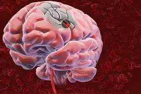 脑梗是拖出来的？医生提醒：6个表现或是脑梗的前兆，请引起重视图片