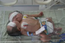 11年前四川孕妇迎来了“双头宝宝”，父母想放弃抚养，后来怎样了图片