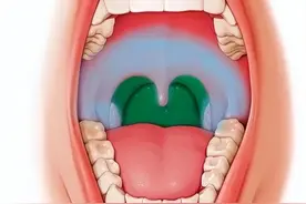欧阳医生：疱疹性咽峡炎真的那么可怕吗？中医教你预防和治疗图片
