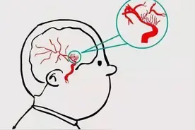 脑出血也有“黄金恢复期”，抓住这段时间很重要图片