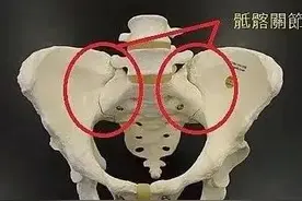 常见腰腿痛病因之一:骶髂关节错位图片