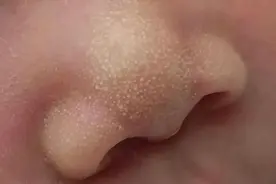 粟粒疹、红斑、痤疮......常见新生儿皮疹妈妈要了解图片