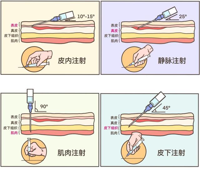 皮下注射是a指将药物注入到皮下组织,就是23打在皮肤和肌肉之间的w