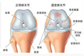 膝盖出现肿胀和疼痛是什么原因引起的？图片