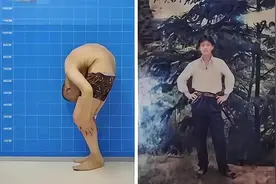 罕见折叠人被敲断4次骨头，植入22颗钢钉，28年后开启直立人生图片