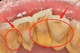 这才是去除牙结石的最根本方法！用完牙石哗哗掉，压根不用洗牙！图片